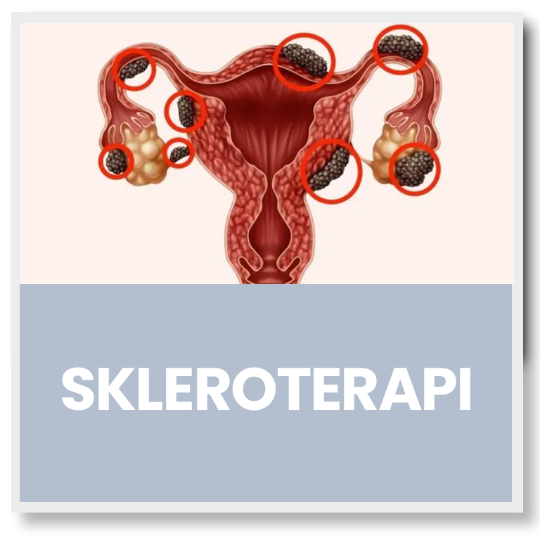 button_skleroterapi_rsia_gladiool